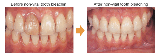 Non-Vital Tooth Bleaching (walking bleach)